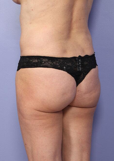 Brazilian Butt Lift Before & After Image