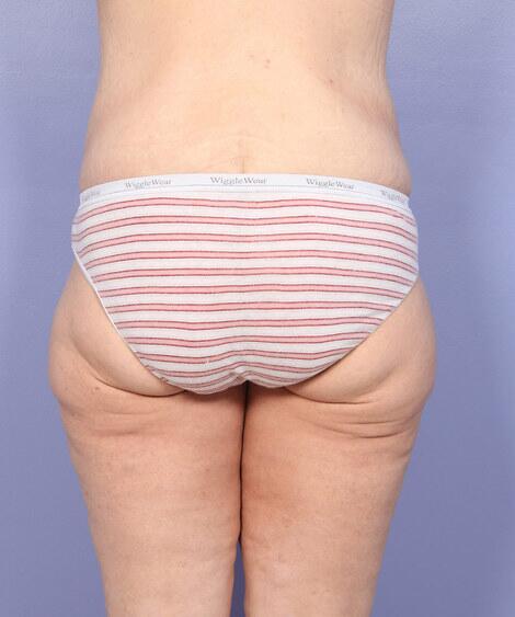 Brazilian Butt Lift Before & After Image