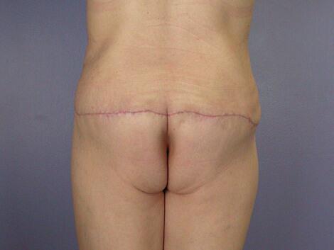 Brazilian Butt Lift Before & After Image