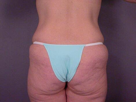 Brazilian Butt Lift Before & After Image