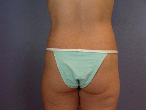 Brazilian Butt Lift Before & After Image