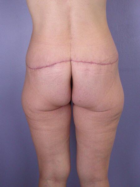 Brazilian Butt Lift Before & After Image