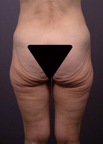 Brazilian Butt Lift Before & After Image