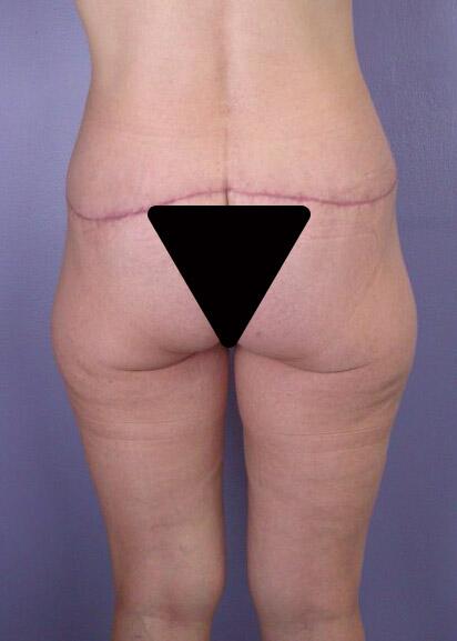 Brazilian Butt Lift Before & After Image