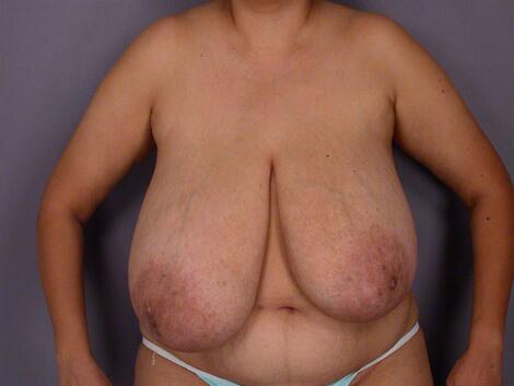 Breast Asymmetry Correction Before & After Image