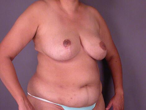 Breast Asymmetry Correction Before & After Image