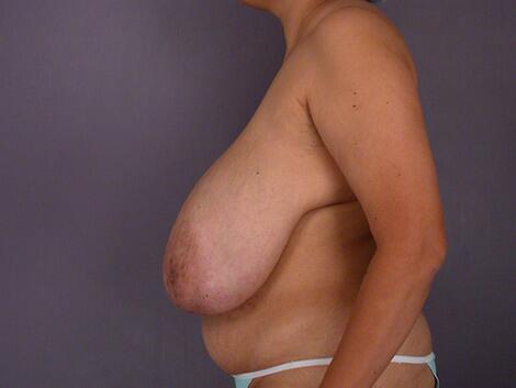 Breast Asymmetry Correction Before & After Image