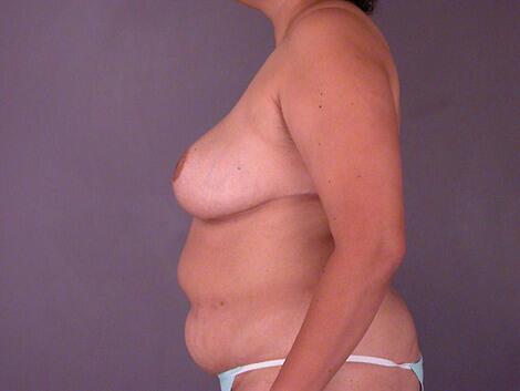 Breast Asymmetry Correction Before & After Image