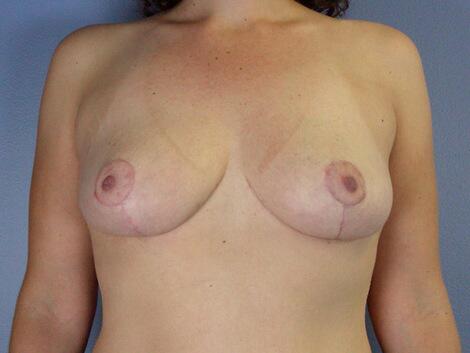 Breast Asymmetry Correction Before & After Image