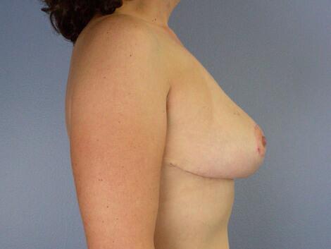 Breast Asymmetry Correction Before & After Image