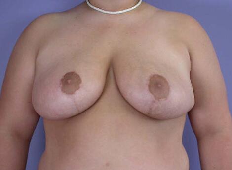 Breast Asymmetry Correction Before & After Image