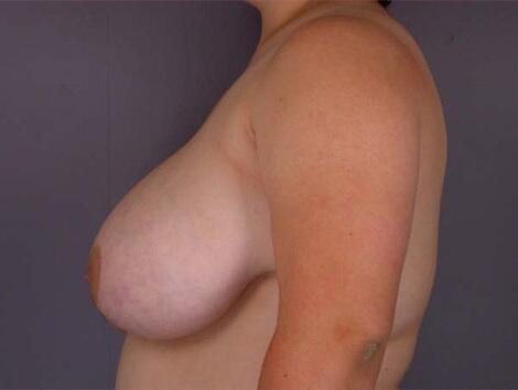 Breast Asymmetry Correction Before & After Image