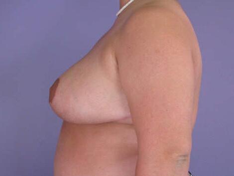 Breast Asymmetry Correction Before & After Image