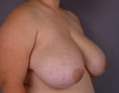 Breast Asymmetry Correction Before & After Image