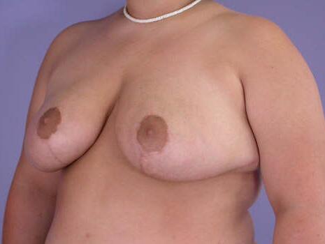 Breast Asymmetry Correction Before & After Image