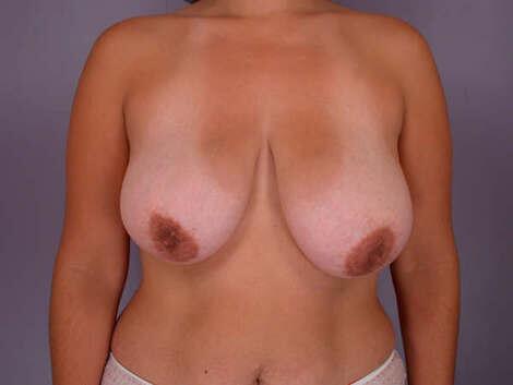 Breast Asymmetry Correction Before & After Image