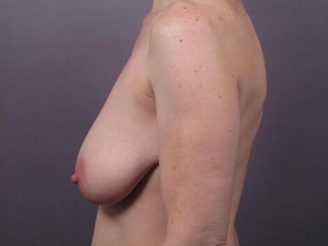 Breast Asymmetry Correction Before & After Image