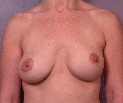 Breast Asymmetry Correction Before & After Image