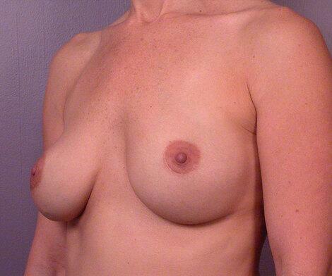 Breast Asymmetry Correction Before & After Image