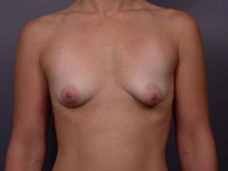 Breast Asymmetry Correction Before & After Image