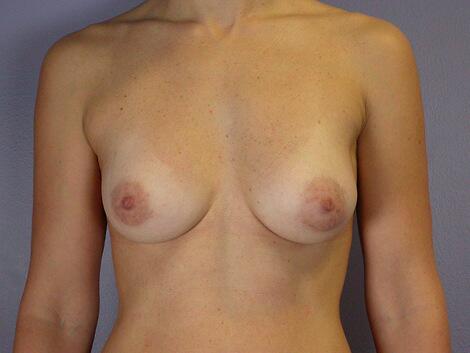 Breast Asymmetry Correction Before & After Image