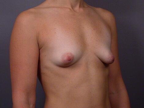 Breast Asymmetry Correction Before & After Image