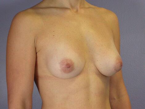 Breast Asymmetry Correction Before & After Image