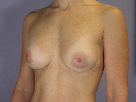 Breast Asymmetry Correction Before & After Image