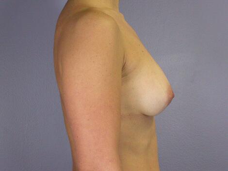 Breast Asymmetry Correction Before & After Image