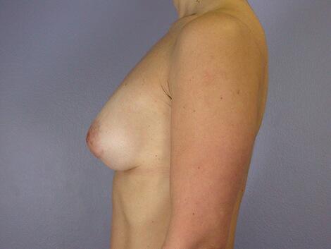 Breast Asymmetry Correction Before & After Image