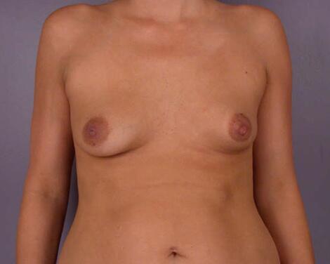 Breast Asymmetry Correction Before & After Image