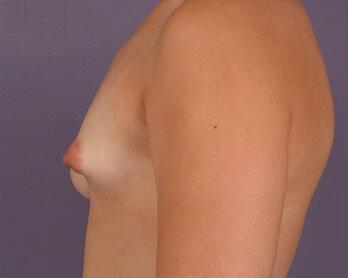 Breast Asymmetry Correction Before & After Image