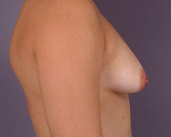 Breast Asymmetry Correction Before & After Image