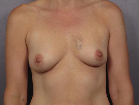 Breast Asymmetry Correction Before & After Image