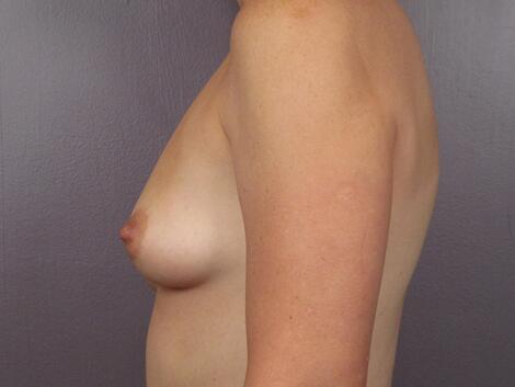 Breast Asymmetry Correction Before & After Image