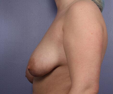 Breast Asymmetry Correction Before & After Image