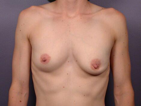 Breast Asymmetry Correction Before & After Image