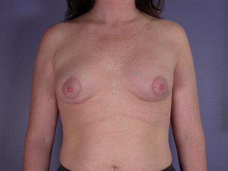 Breast Asymmetry Correction Before & After Image