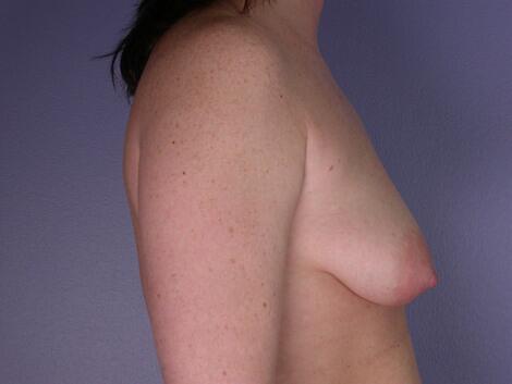 Breast Asymmetry Correction Before & After Image