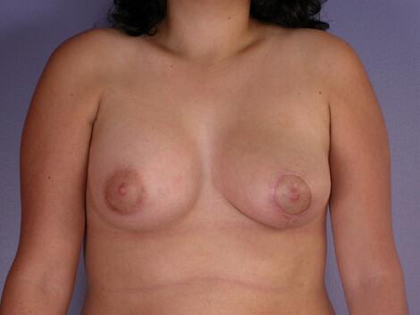 Breast Asymmetry Correction Before & After Image