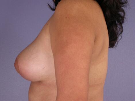 Breast Asymmetry Correction Before & After Image