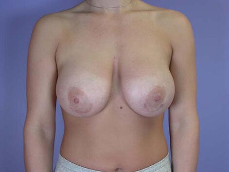 Breast Asymmetry Correction Before & After Image