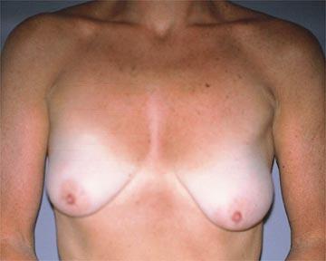 Breast Asymmetry Correction Before & After Image