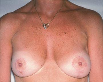 Breast Asymmetry Correction Before & After Image