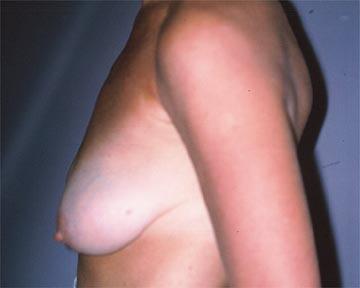 Breast Asymmetry Correction Before & After Image