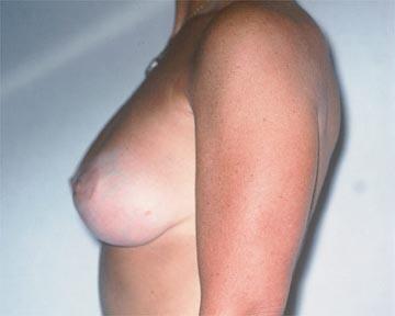 Breast Asymmetry Correction Before & After Image