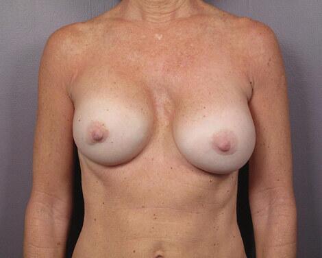 Breast Asymmetry Correction Before & After Image