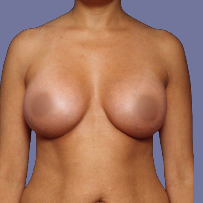 Breast Augmentation Before & After Image