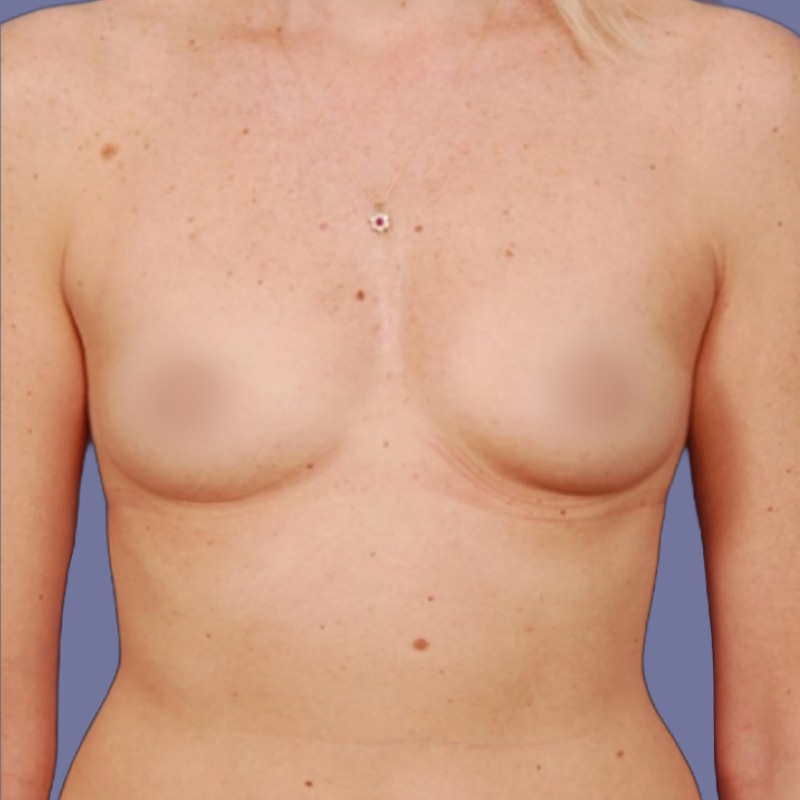 Breast Augmentation Before & After Image