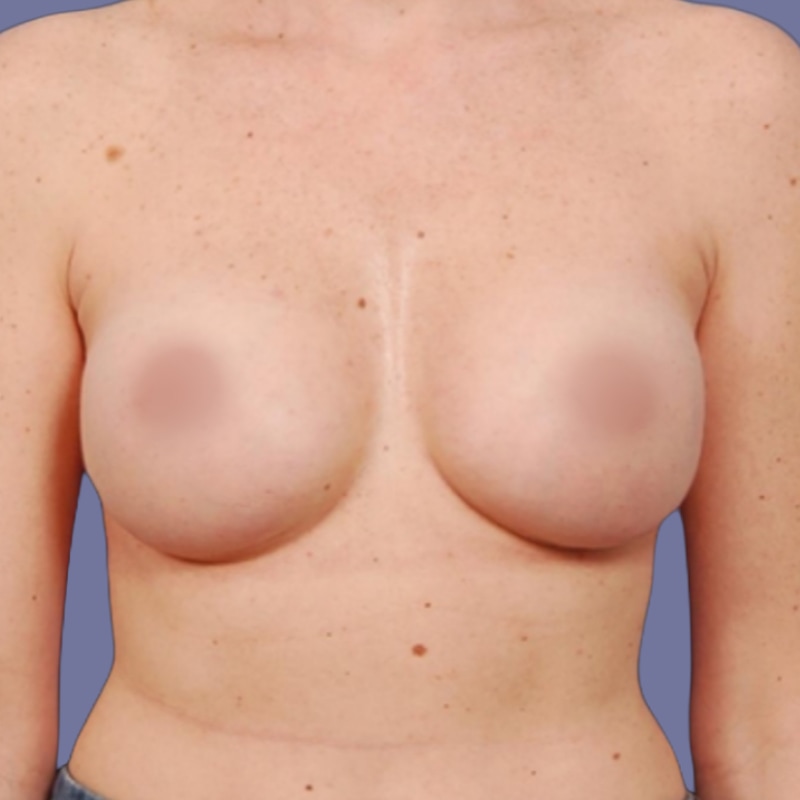 Breast Augmentation Before & After Image